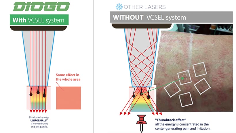 Technical comparison graphic from XOD illustrating diode laser technology differences